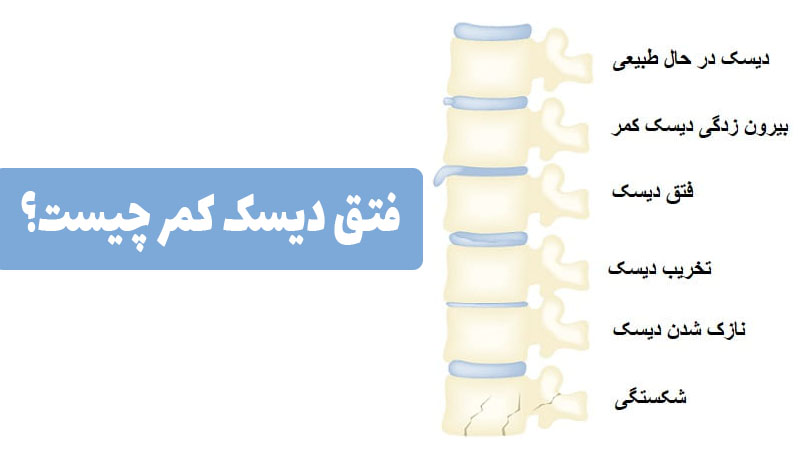 فتق دیسک کمر چیست؟